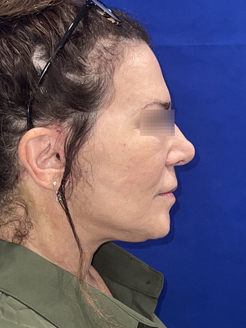 Face Lift Before & After Gallery - Patient 242829 - Image 5