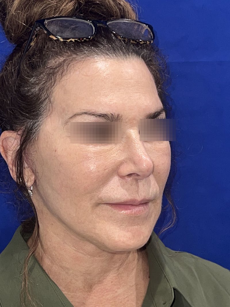 Face Lift Before & After Gallery - Patient 242829 - Image 1
