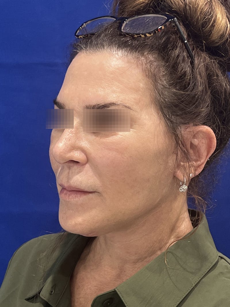 Face Lift Before & After Gallery - Patient 242829 - Image 7