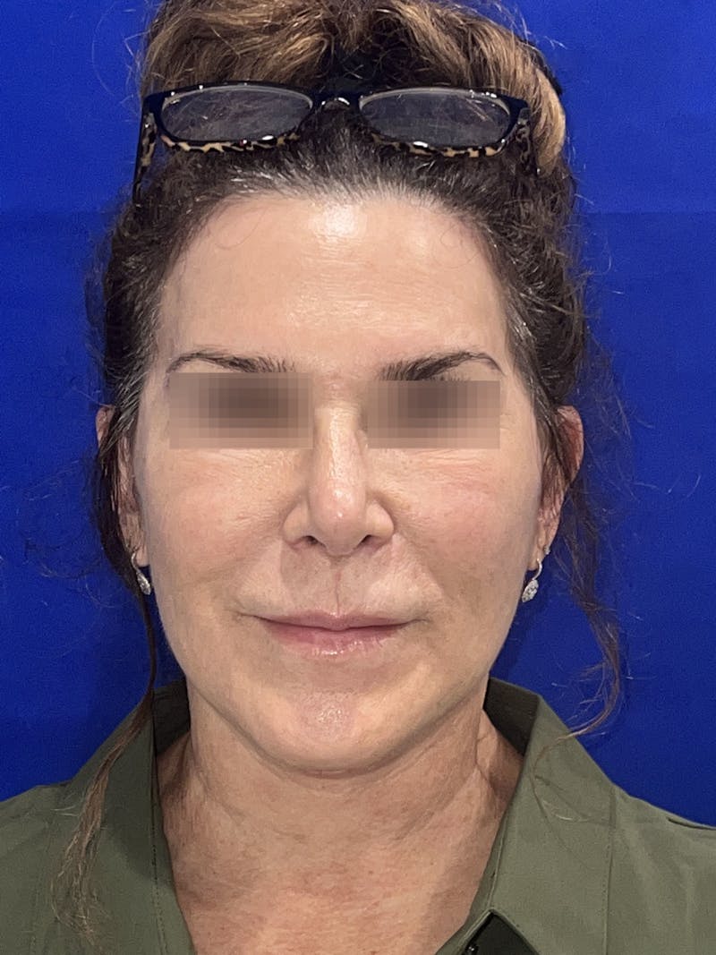 Face Lift Before & After Gallery - Patient 242829 - Image 9