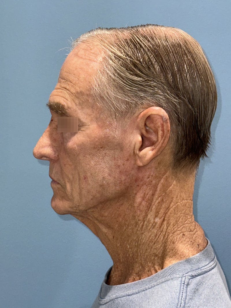 Face Lift Before & After Gallery - Patient 249179 - Image 3