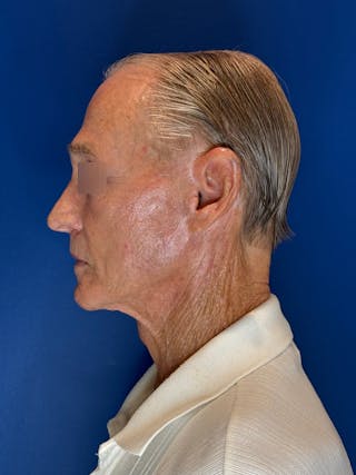 Brow Lift Before & After Gallery - Patient 212623 - Image 12