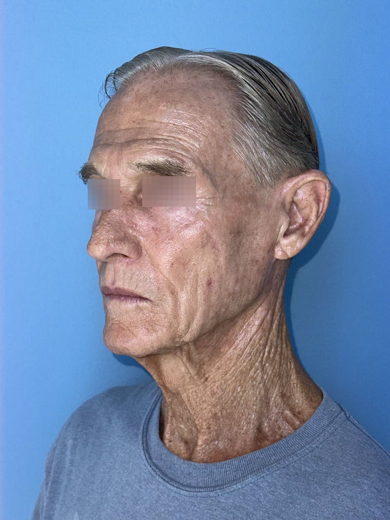 Face Lift Before & After Gallery - Patient 249179 - Image 5