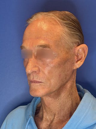 Brow Lift Before & After Gallery - Patient 212623 - Image 10