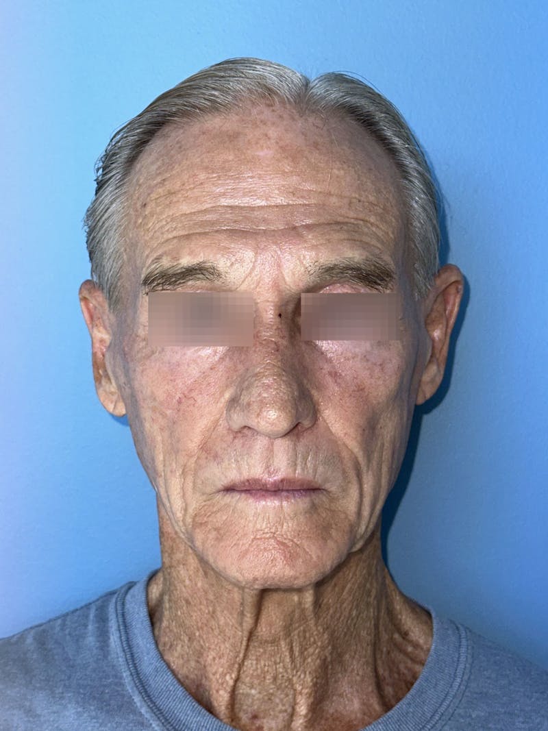 Face Lift Before & After Gallery - Patient 249179 - Image 7