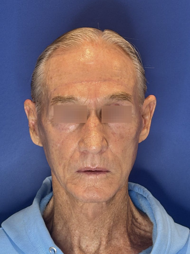 Face Lift Before & After Gallery - Patient 249179 - Image 8