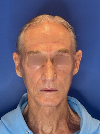 Brow Lift Before & After Gallery - Patient 212623 - Image 4