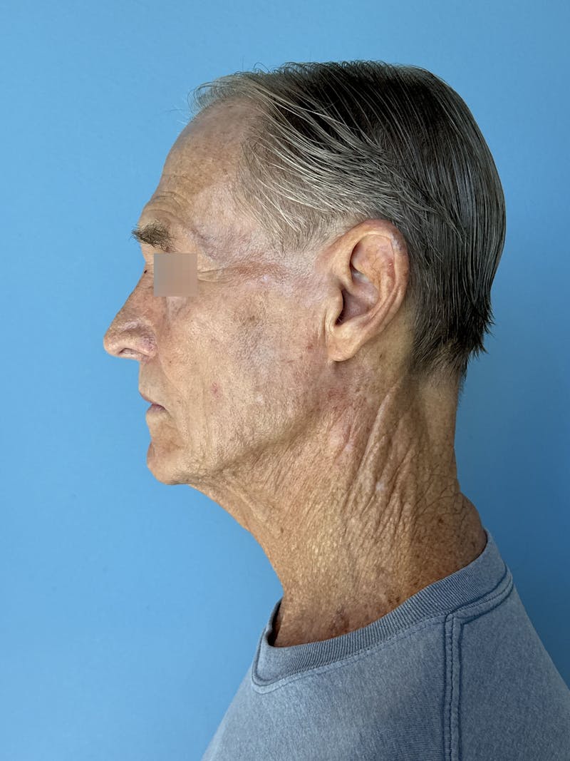 Face Lift Before & After Gallery - Patient 249179 - Image 9