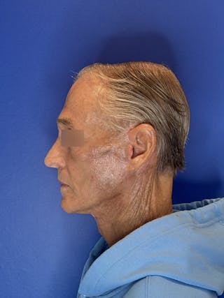 Brow Lift Before & After Gallery - Patient 212623 - Image 16