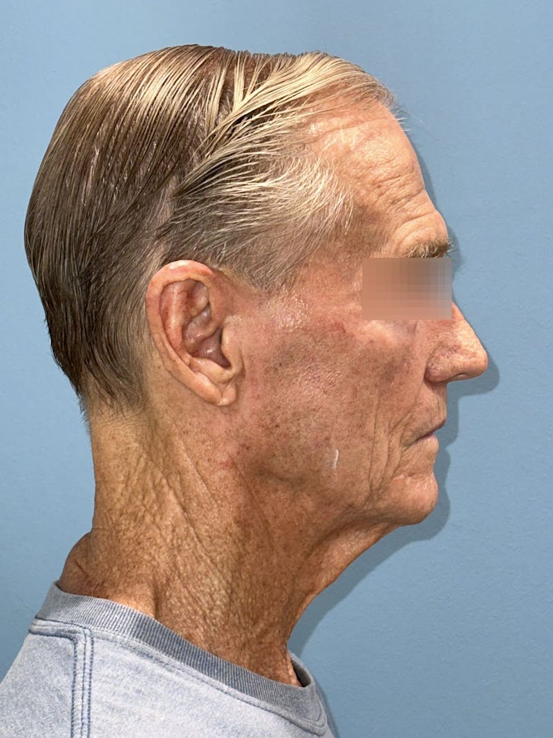 Face Lift Before & After Gallery - Patient 249179 - Image 11