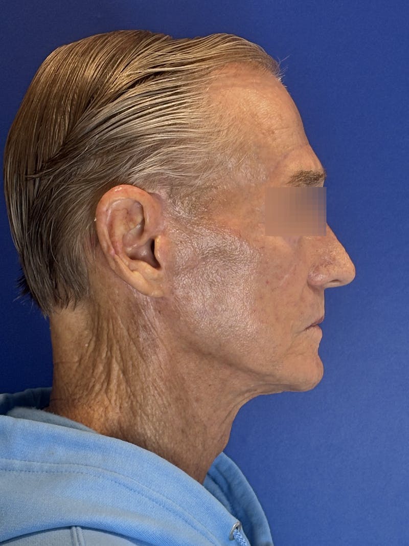 Face Lift Before & After Gallery - Patient 249179 - Image 12