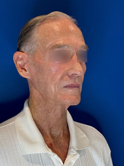 Face Lift Before & After Gallery - Patient 249179 - Image 2