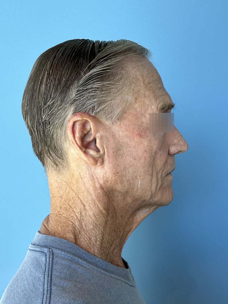 Face Lift Before & After Gallery - Patient 249179 - Image 13