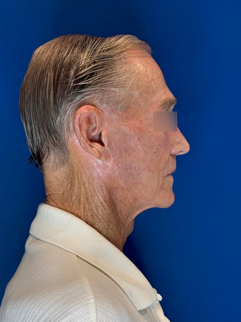 Face Lift Before & After Gallery - Patient 249179 - Image 14