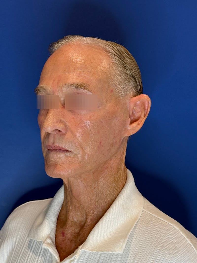 Face Lift Before & After Gallery - Patient 249179 - Image 16