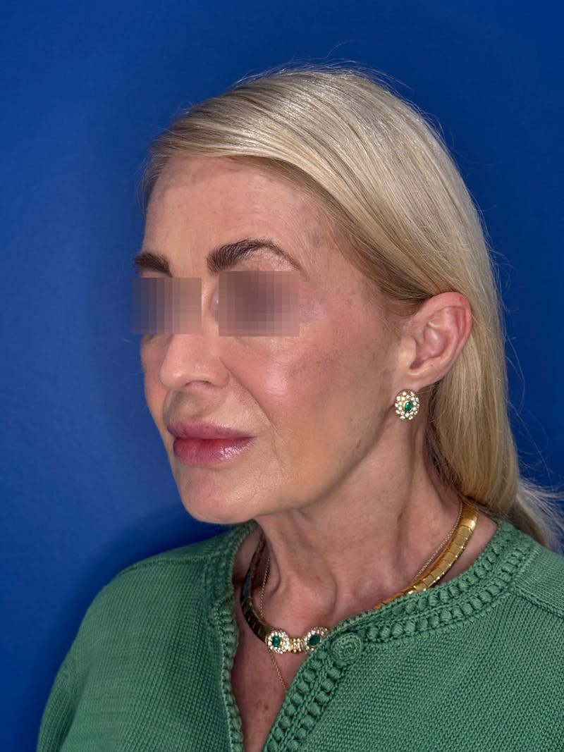 Face Lift Before & After Gallery - Patient 147123 - Image 3