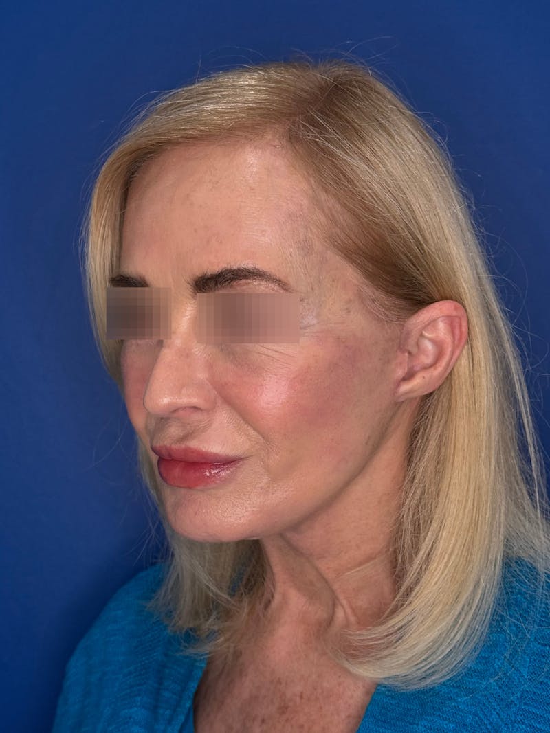 Face Lift Before & After Gallery - Patient 147123 - Image 4