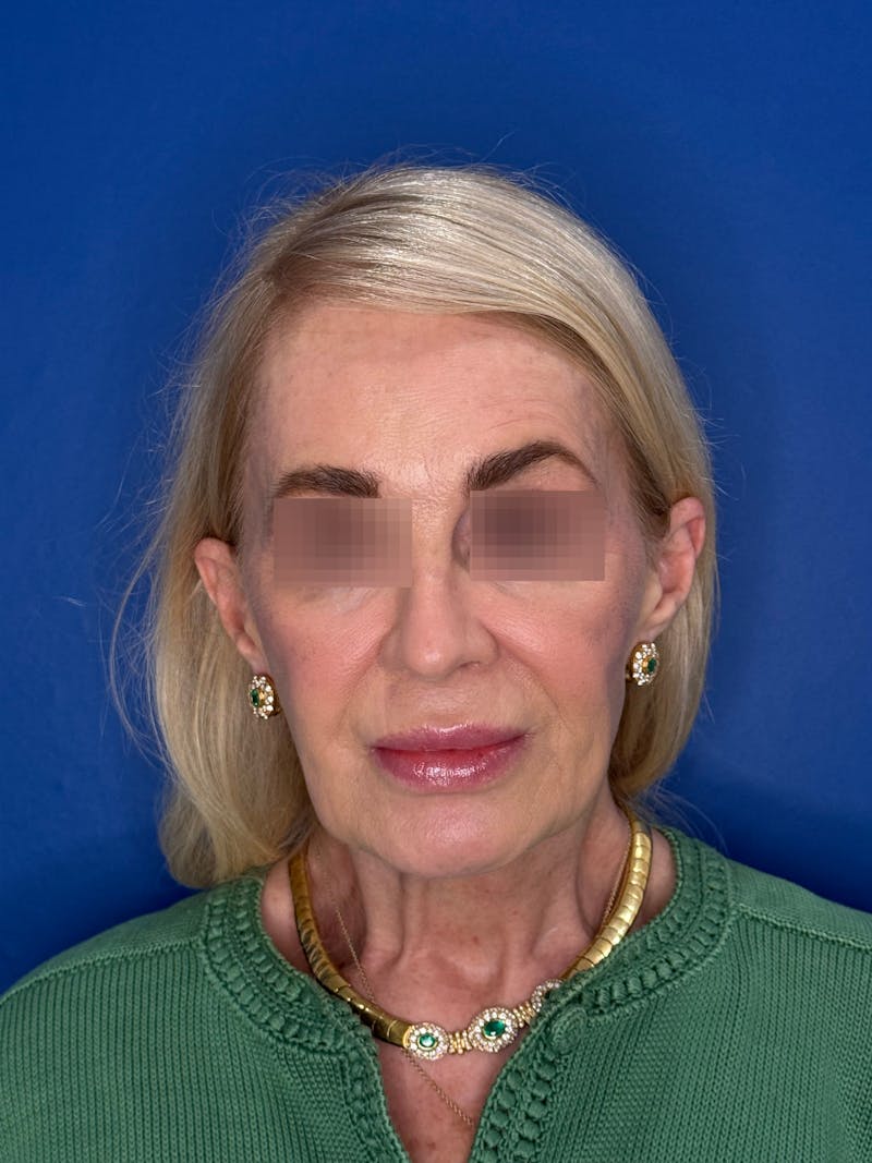 Face Lift Before & After Gallery - Patient 147123 - Image 5