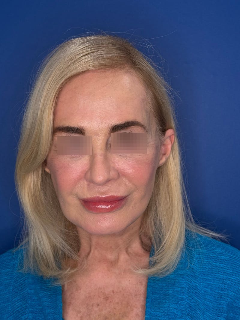 Face Lift Before & After Gallery - Patient 147123 - Image 6