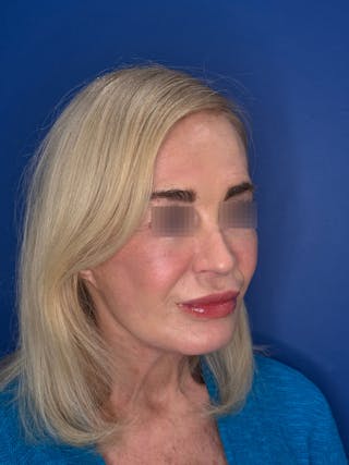 Face Lift Before & After Gallery - Patient 147123 - Image 2