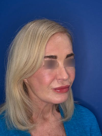 Face Lift Before & After Gallery - Patient 147123 - Image 2