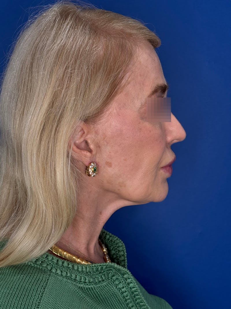 Face Lift Before & After Gallery - Patient 147123 - Image 7