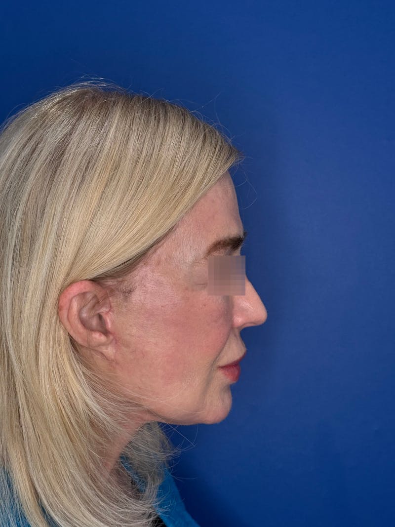 Face Lift Before & After Gallery - Patient 147123 - Image 8