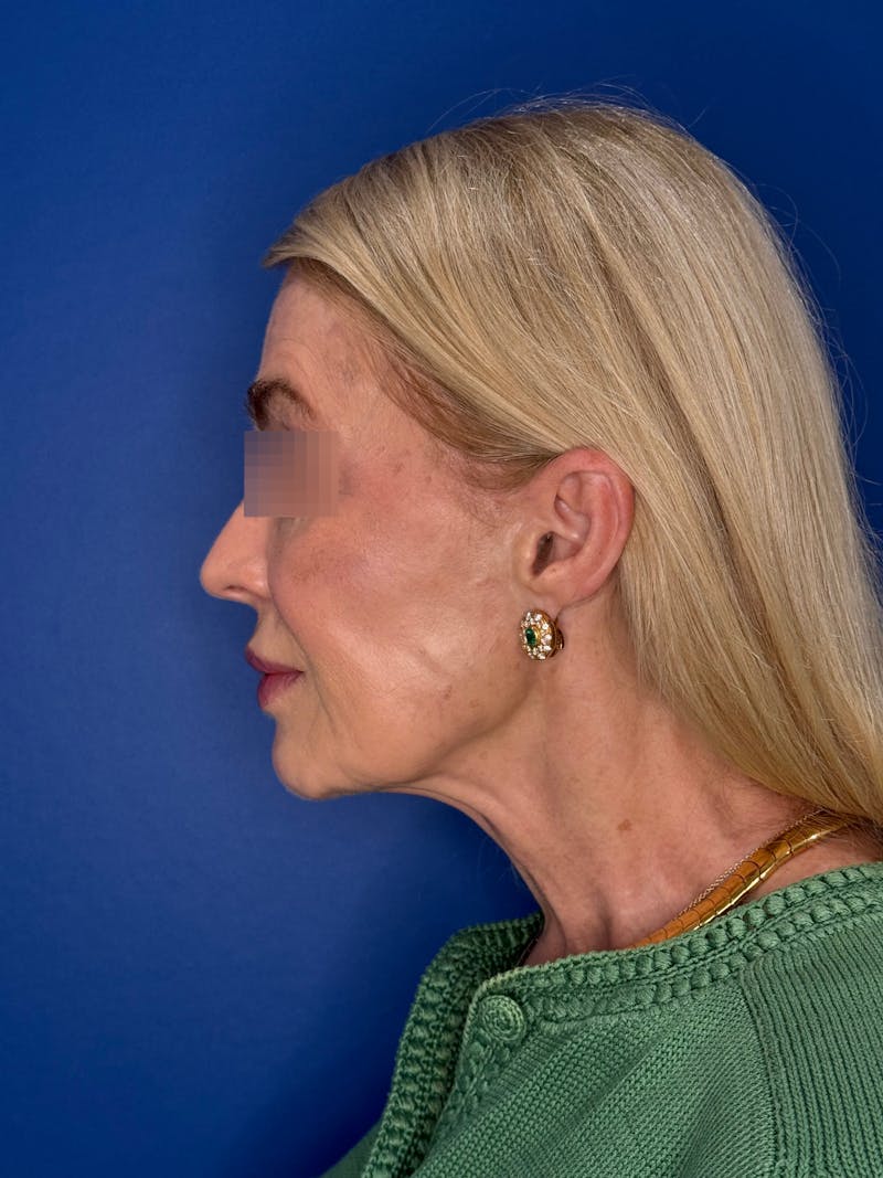 Face Lift Before & After Gallery - Patient 147123 - Image 9