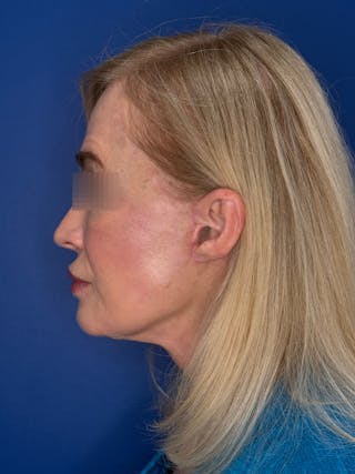 Face Lift Before & After Gallery - Patient 147123 - Image 10