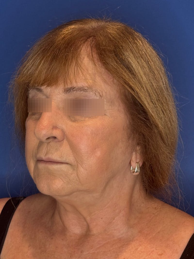 Face Lift Before & After Gallery - Patient 340457 - Image 3
