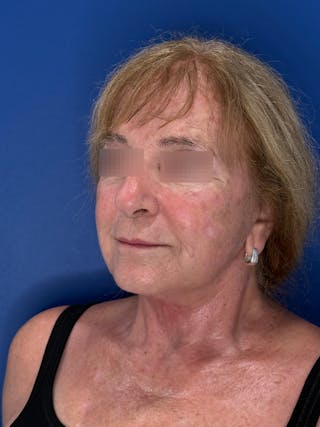 Face Lift Before & After Gallery - Patient 340457 - Image 4