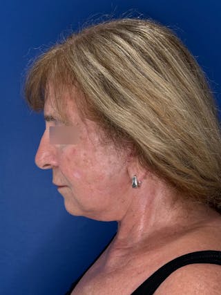 Face Lift Before & After Gallery - Patient 340457 - Image 6