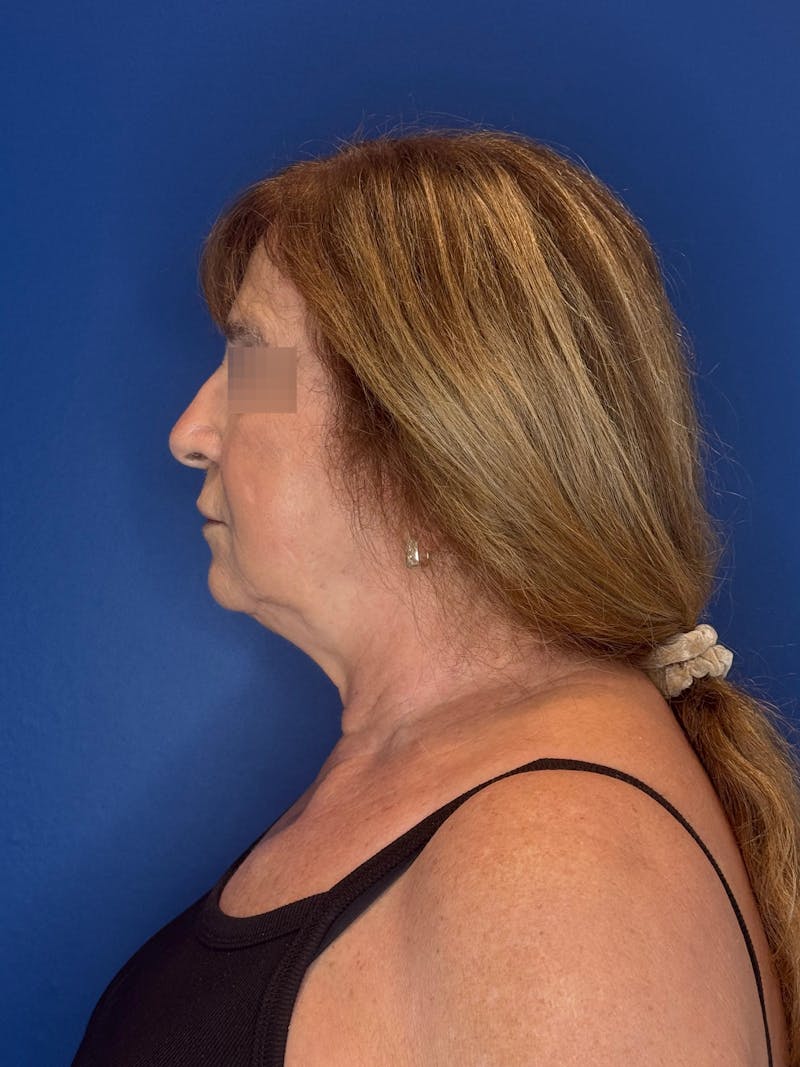 Face Lift Before & After Gallery - Patient 340457 - Image 7