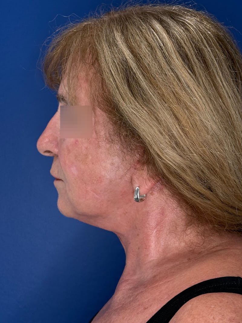 Face Lift Before & After Gallery - Patient 340457 - Image 8