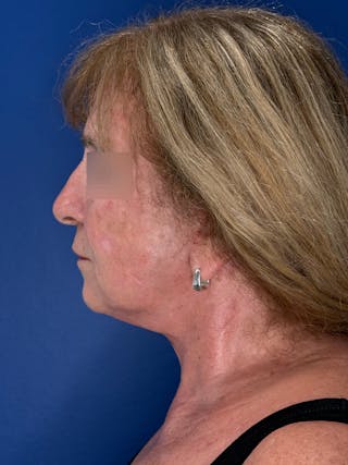 Face Lift Before & After Gallery - Patient 340457 - Image 8