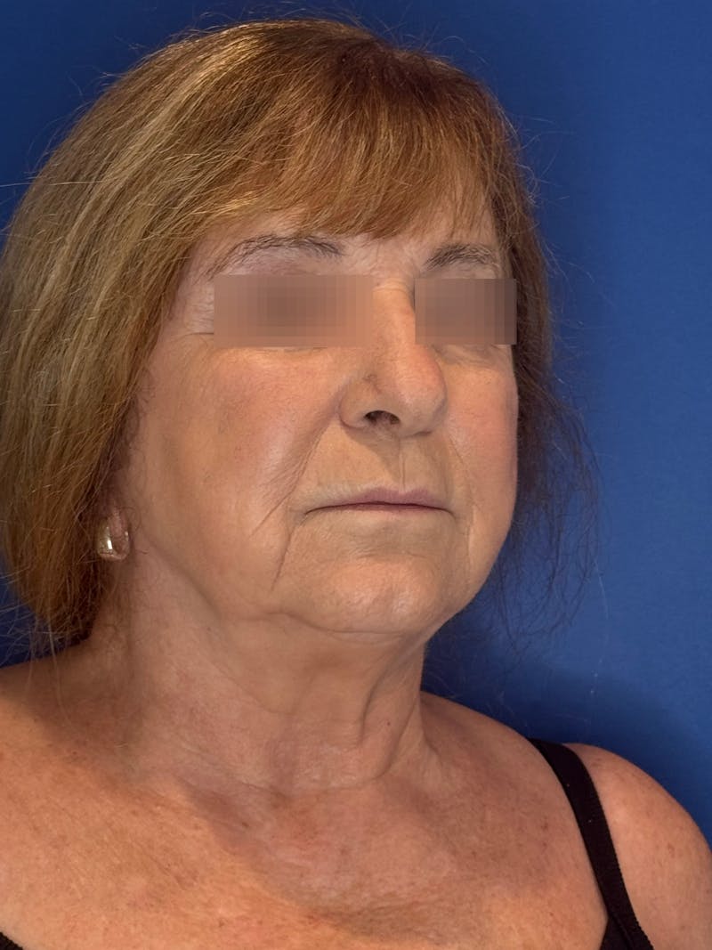 Face Lift Before & After Gallery - Patient 340457 - Image 1