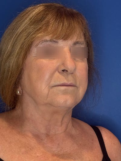 Face Lift Before & After Gallery - Patient 340457 - Image 1