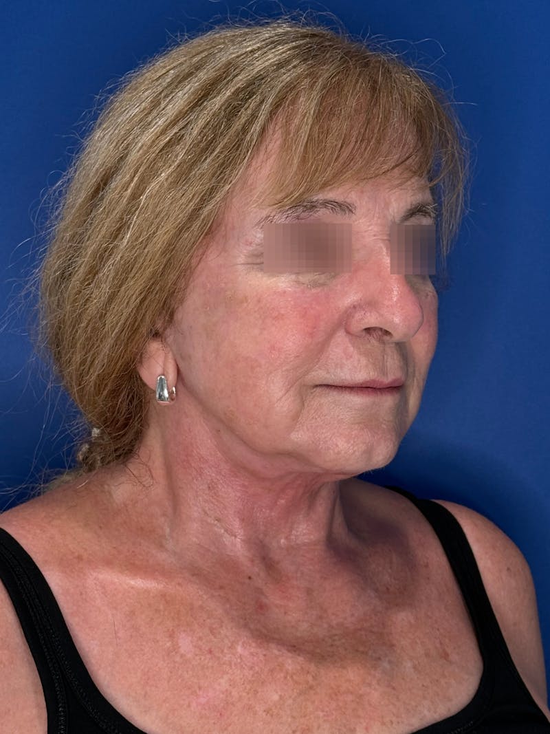 Face Lift Before & After Gallery - Patient 340457 - Image 2