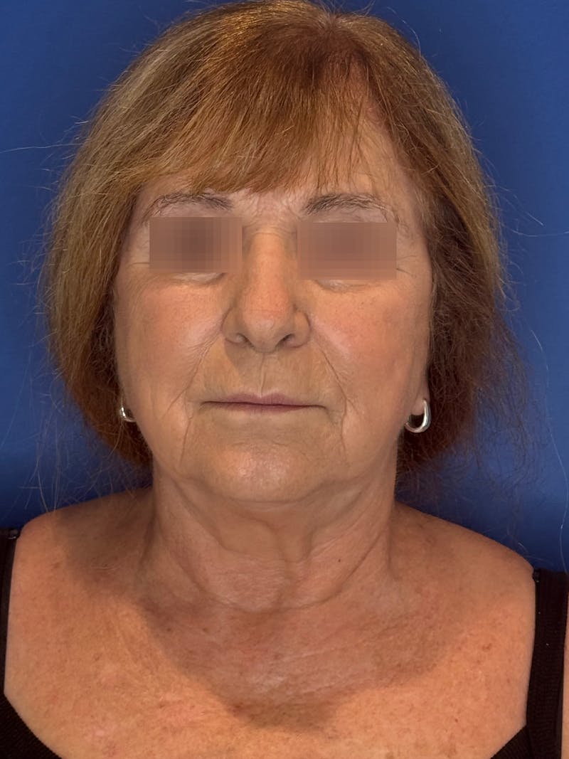 Face Lift Before & After Gallery - Patient 340457 - Image 9