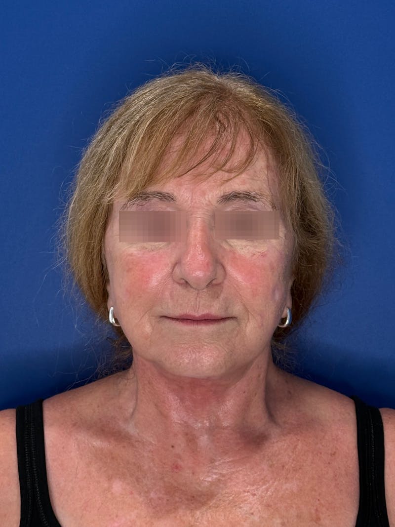 Face Lift Before & After Gallery - Patient 340457 - Image 10