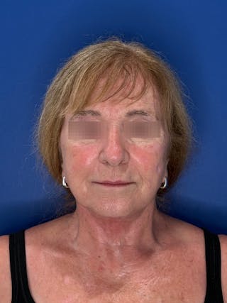 Face Lift Before & After Gallery - Patient 340457 - Image 10