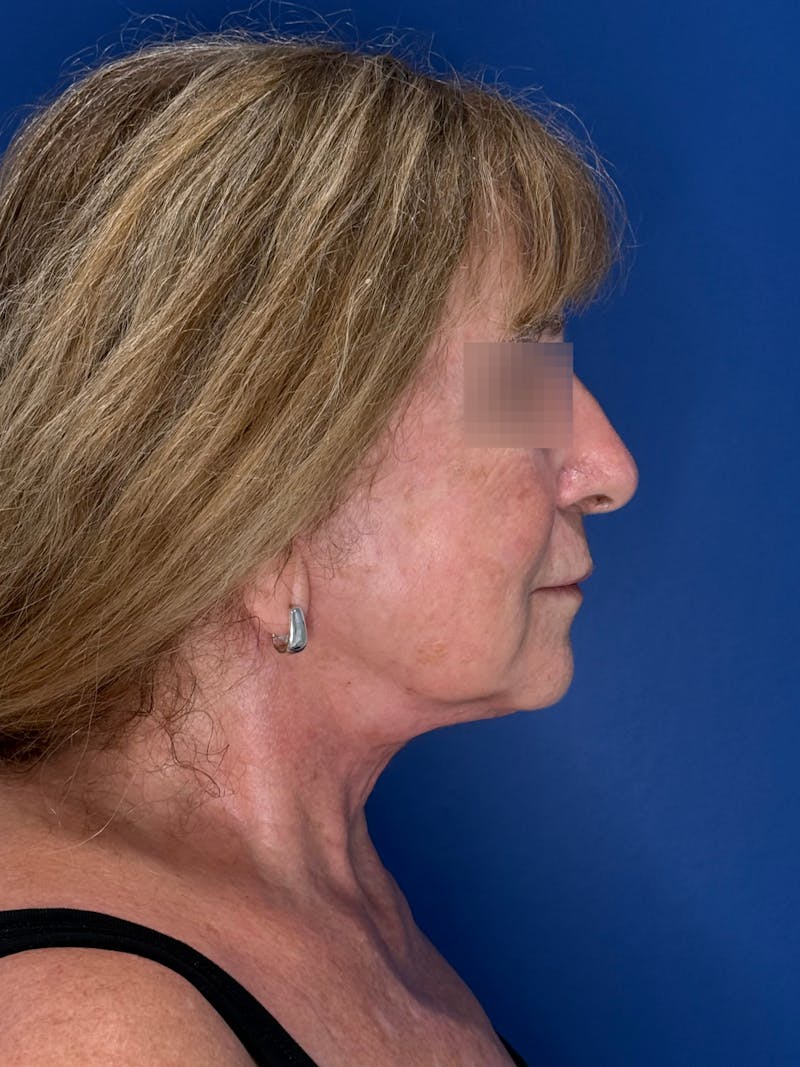 Face Lift Before & After Gallery - Patient 340457 - Image 12