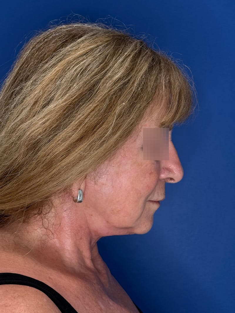 Face Lift Before & After Gallery - Patient 340457 - Image 14