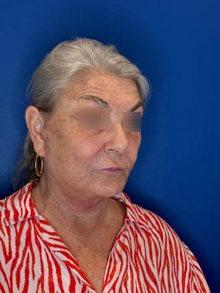 Face Lift Before & After Gallery - Patient 246199 - Image 2