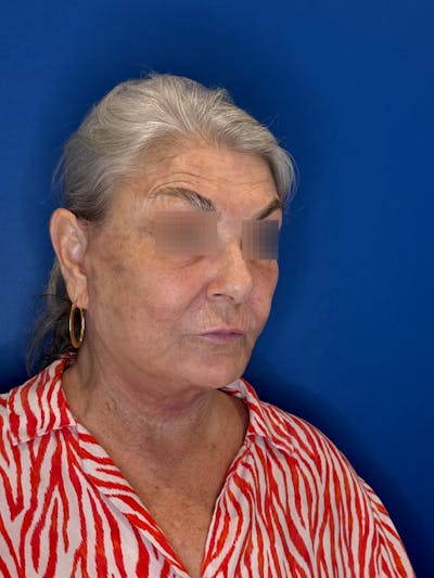 Face Lift Before & After Gallery - Patient 246199 - Image 2