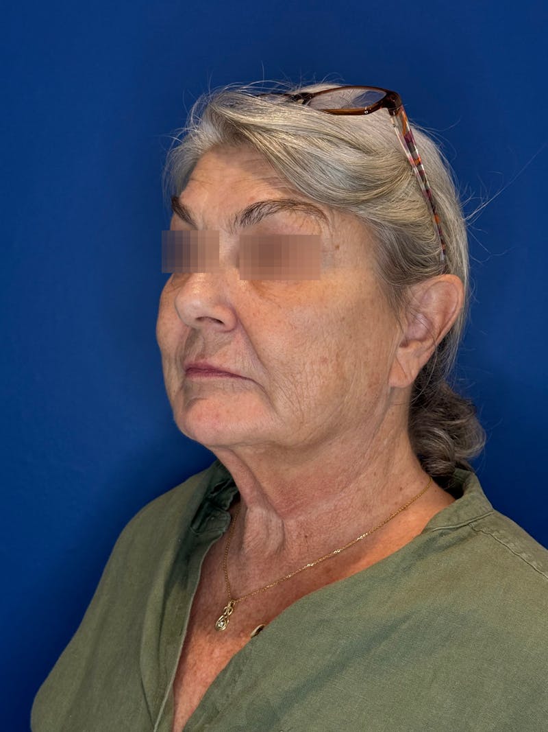 Face Lift Before & After Gallery - Patient 246199 - Image 5