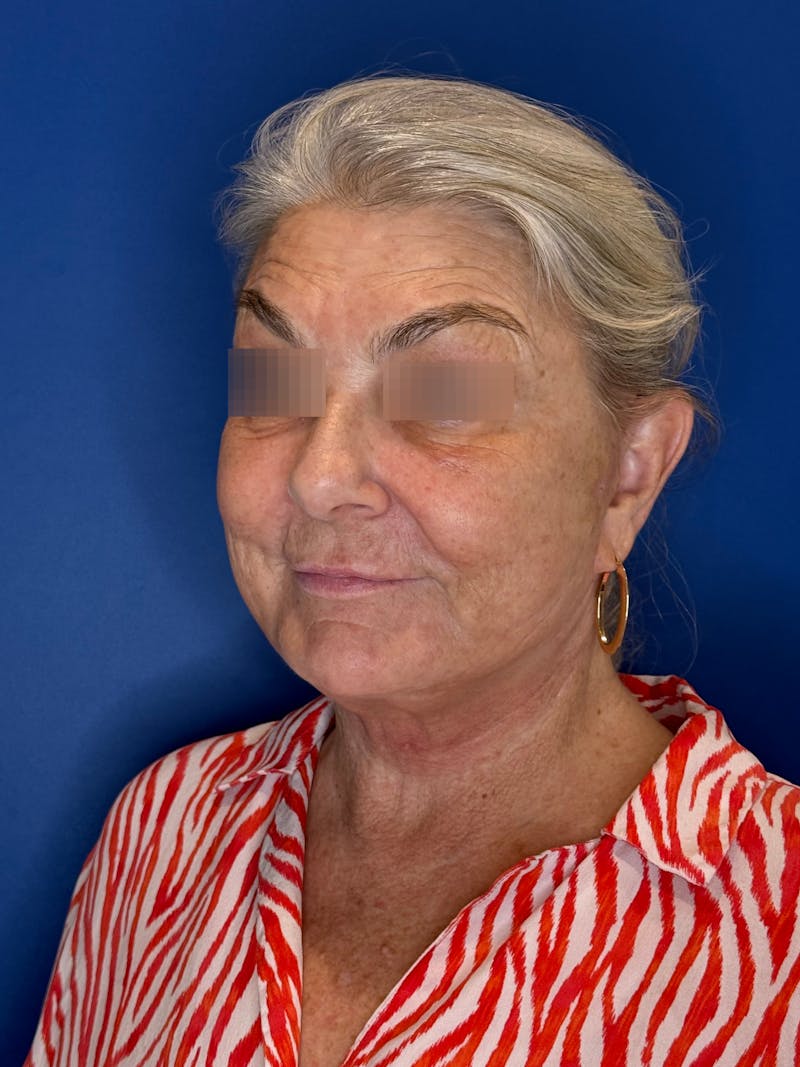 Face Lift Before & After Gallery - Patient 246199 - Image 6