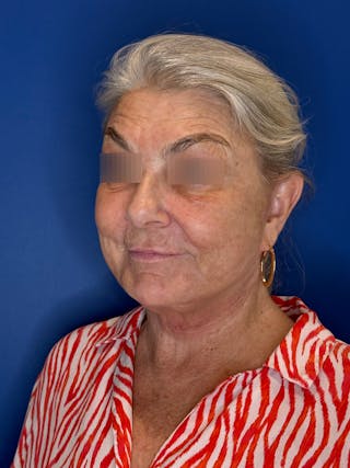Face Lift Before & After Gallery - Patient 246199 - Image 6