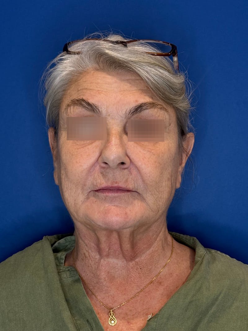 Face Lift Before & After Gallery - Patient 246199 - Image 7