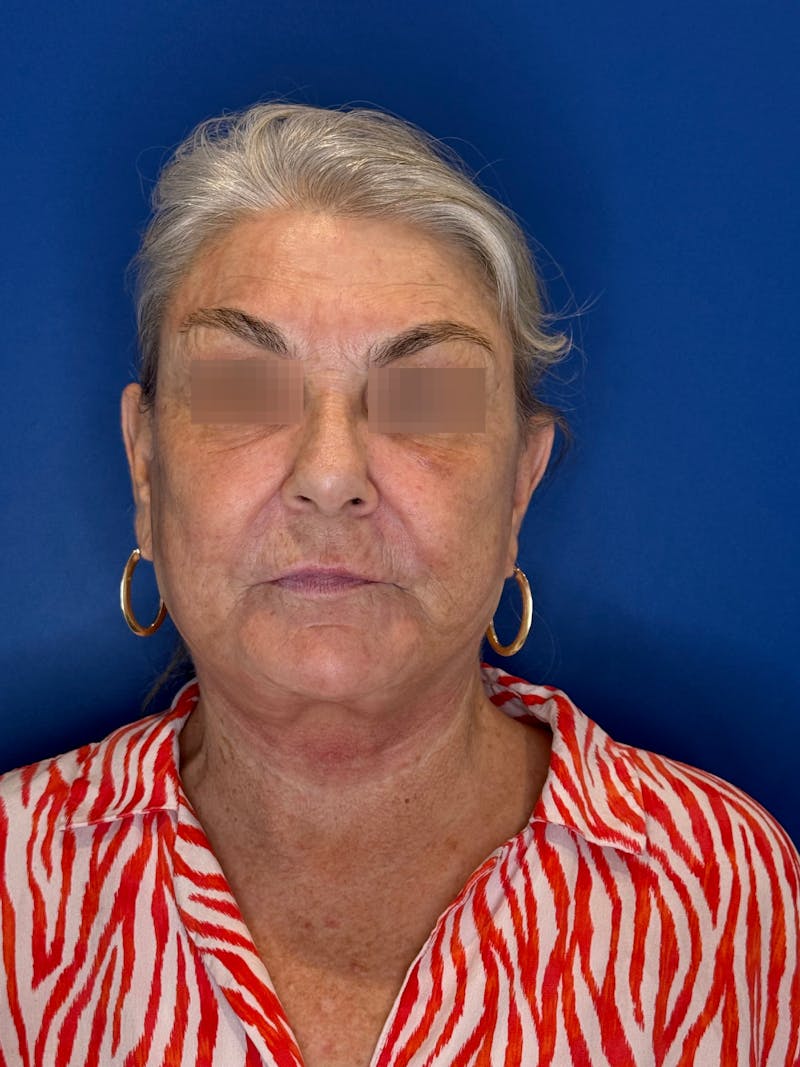 Face Lift Before & After Gallery - Patient 246199 - Image 8